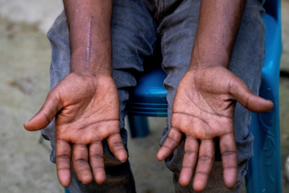 Shipbreaker Mizan Hossain, whose back was crushed in a 10-metre fall, showing his swollen hands - Munir UZ ZAMAN (AFP)