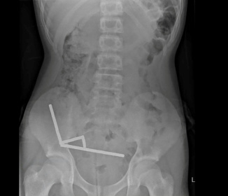 This undated handout released on October 24, 2025 from the New Zealand Medical Journal (NZMJ) shows an x-ray image of pieces of high-power magnets clumped up in the intestines of a New Zealand teenager in Tauranga - Handout (AFP)